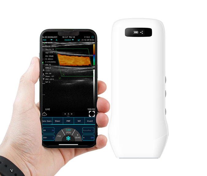 How to Use a Wireless Portable Ultrasound Scanner?