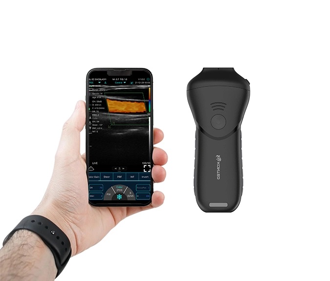 Handheld Ultrasound Devices: A Major Advancement in Medical Technology