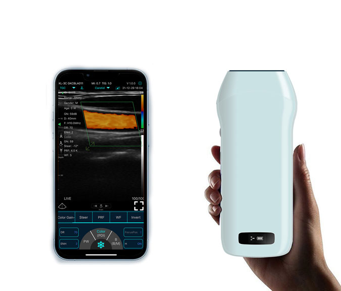 How Wireless Handheld Ultrasound Aids the Development of the Interventional Department